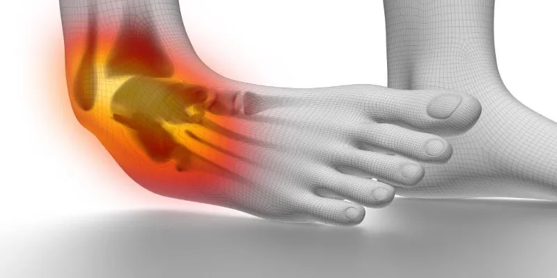 How to know if you Sprained your Ankle?