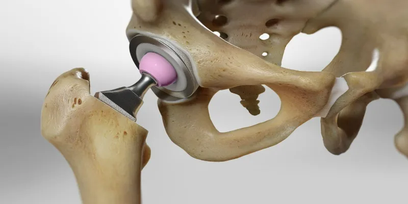 How Long is Hip Replacement Recovery?
