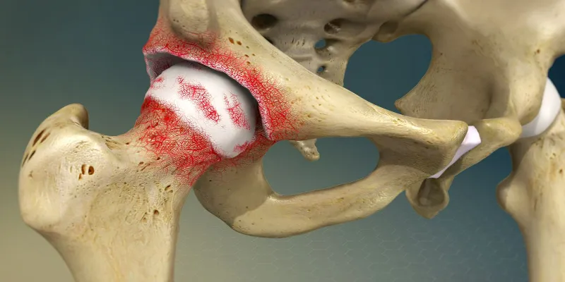 Hip Arthritis: Disease And Its Types | Dr. Sankalp Pande