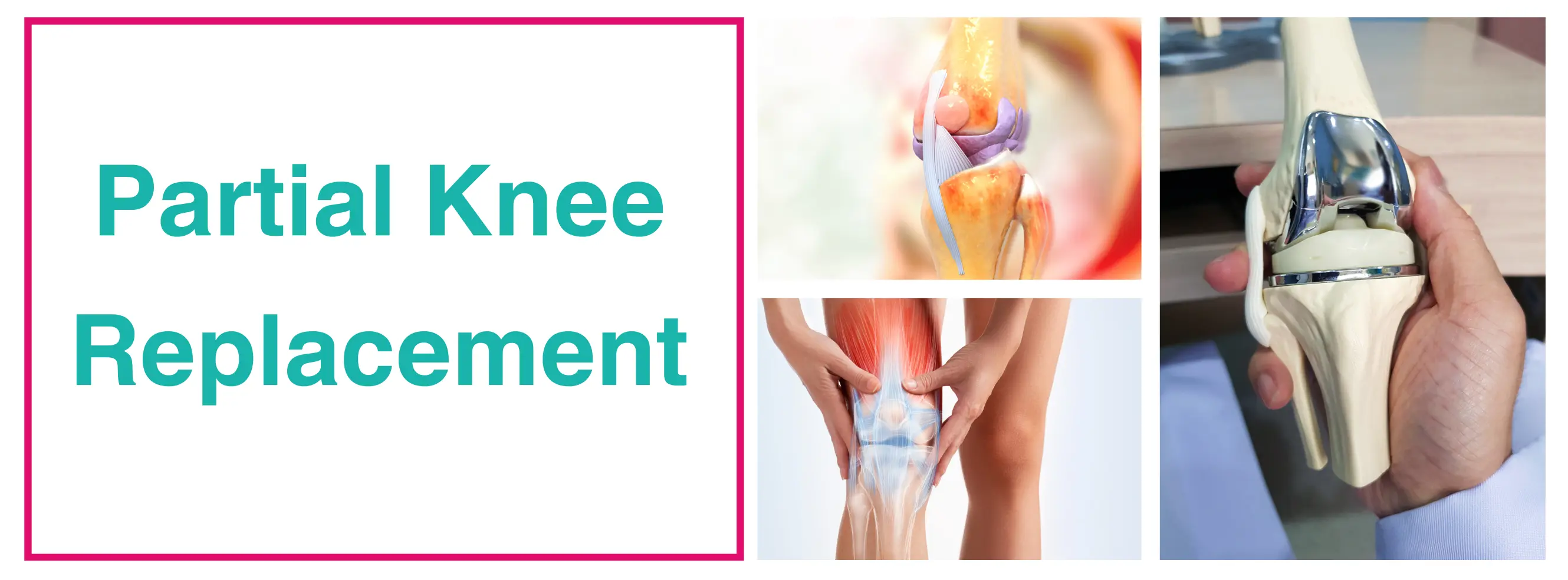 Partial Knee Replacement Surgery In Delhi | Dr. Sankalp Pande