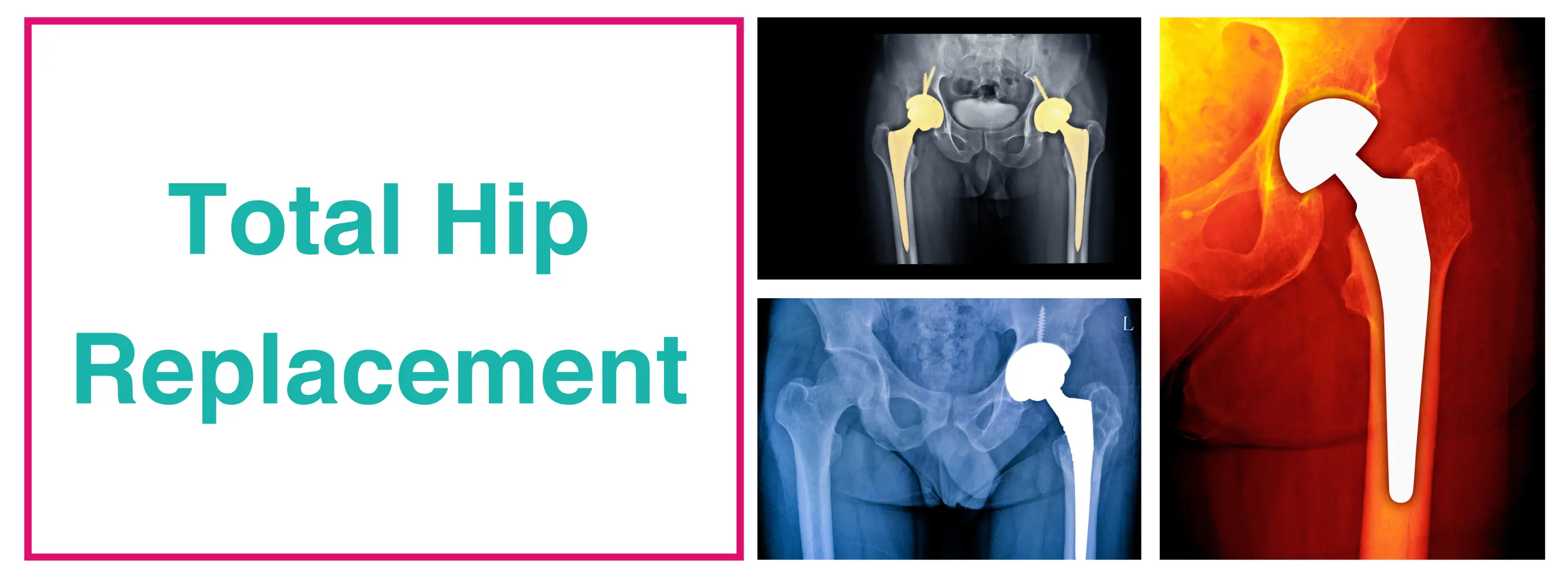 Best Hip Replacement Surgeon In Delhi - Dr. Sankalp Pande