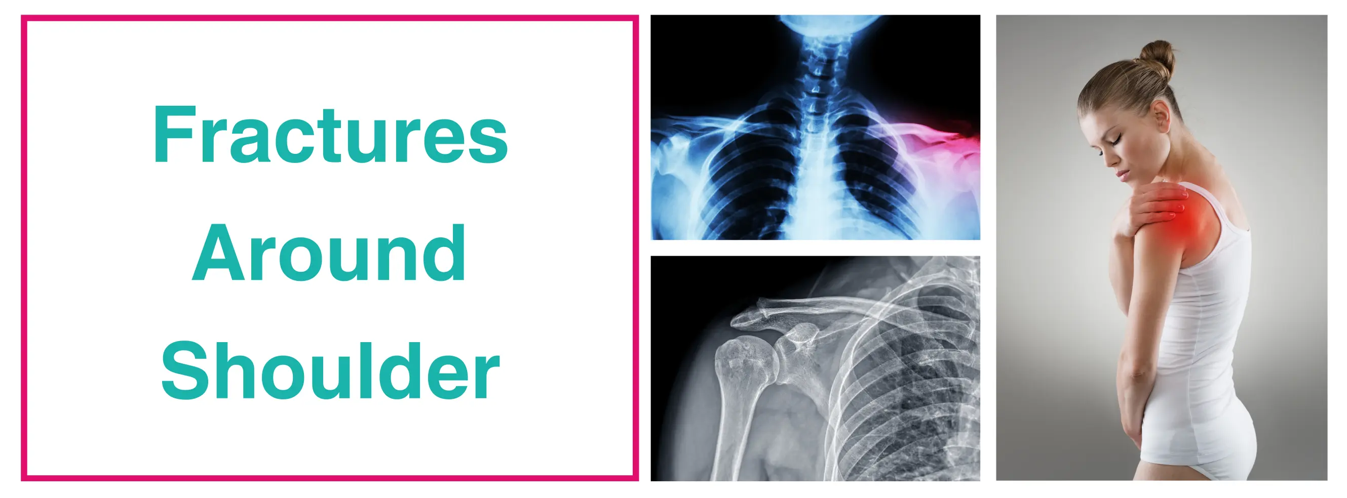 Shoulder Fracture Treatment In Delhi  | Dr. Sankalp Pande
