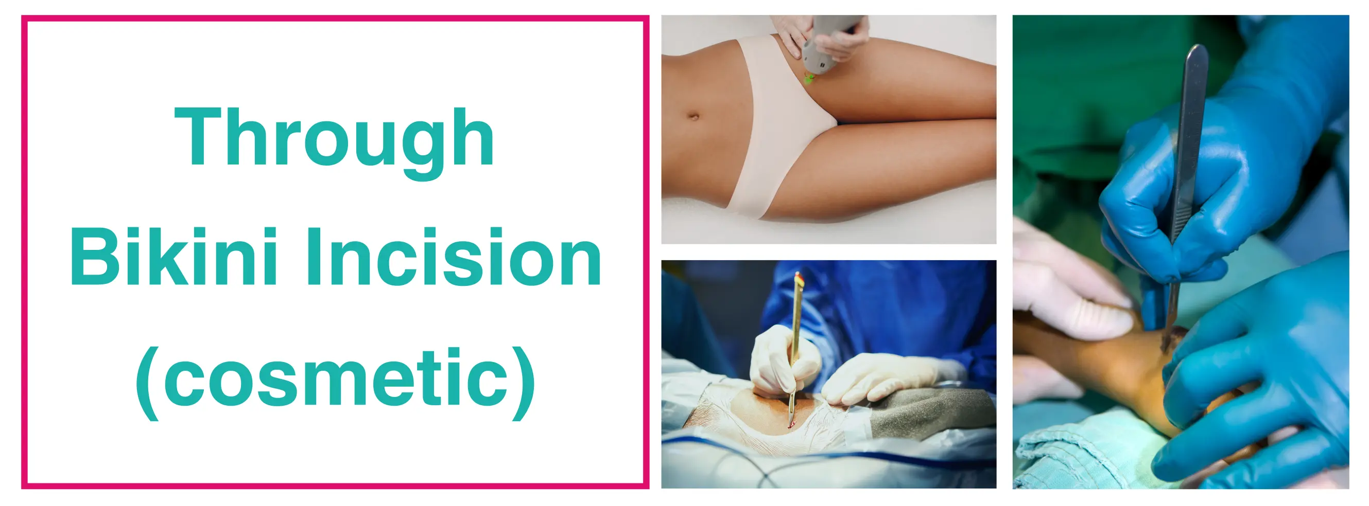 Through Bikini Incision (cosmetic)  | Total Hip Replacement