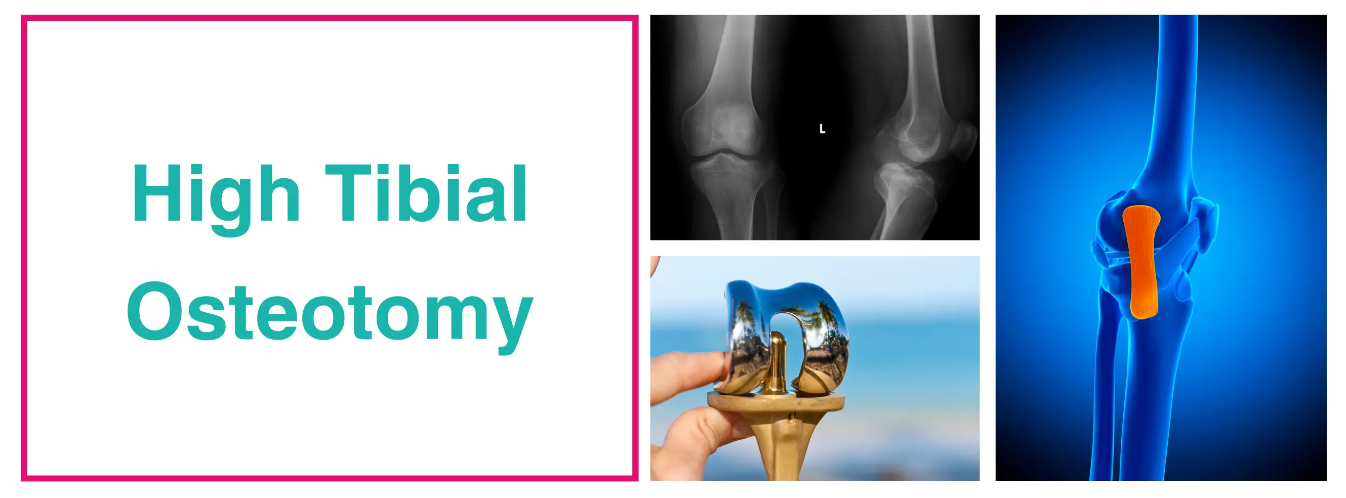 High Tibial Osteotomy (HTO) - Knee Joint Disorders