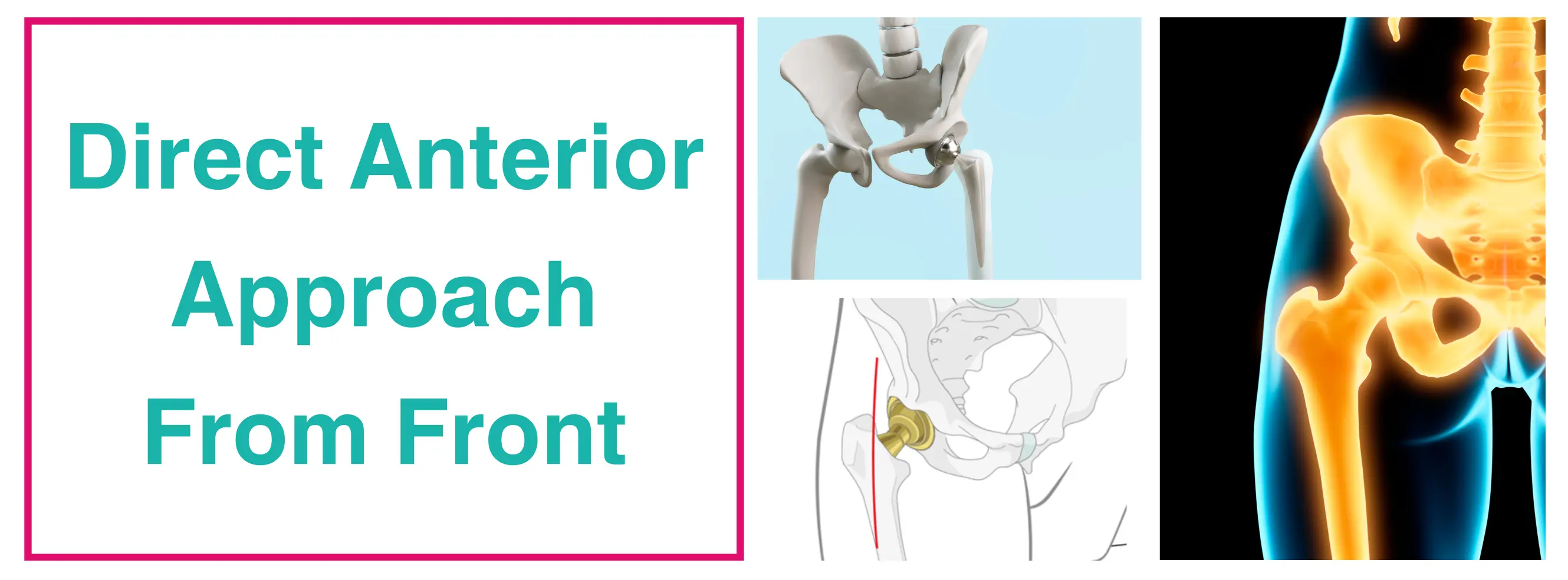 Direct Anterior Approach From Front | Total Hip Replacement