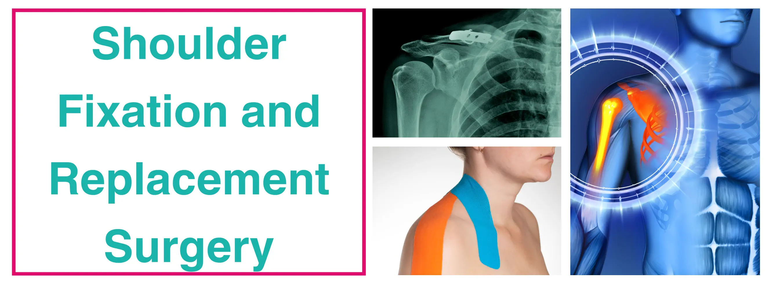 Shoulder - Fixation And Replacement | Dr. Sankalp Pande