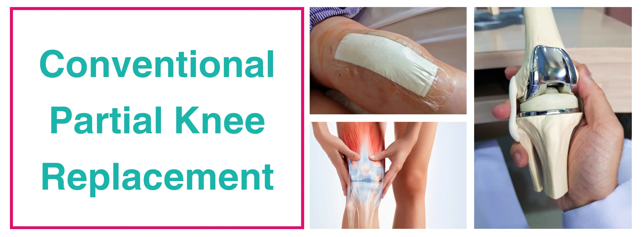 Conventional Partial Knee Replacement | Dr. Sankalp Pande