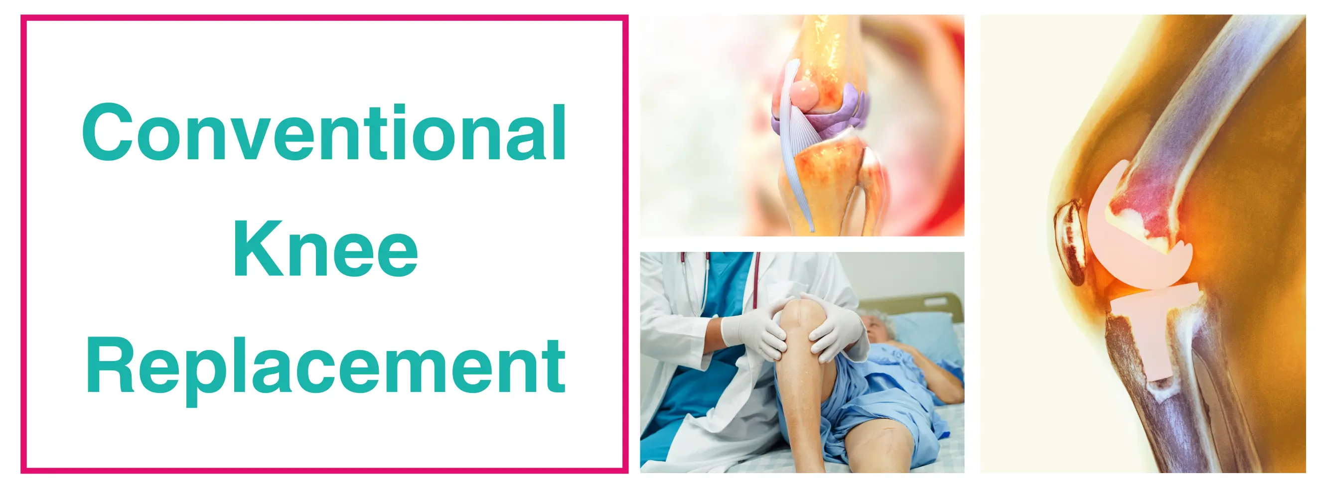 Conventional Knee Replacement Surgery | Dr. Sankalp Pande