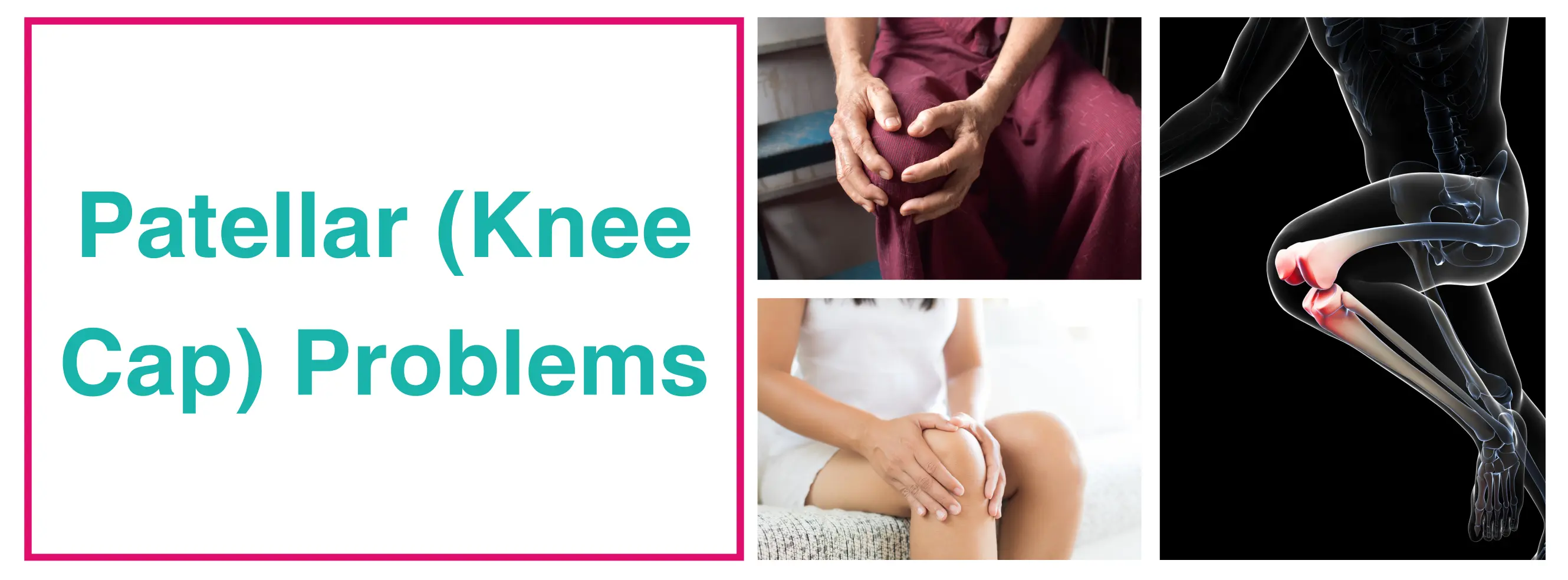 Patellar (Knee Cap) : Diagnosis, Treatment & Prevention