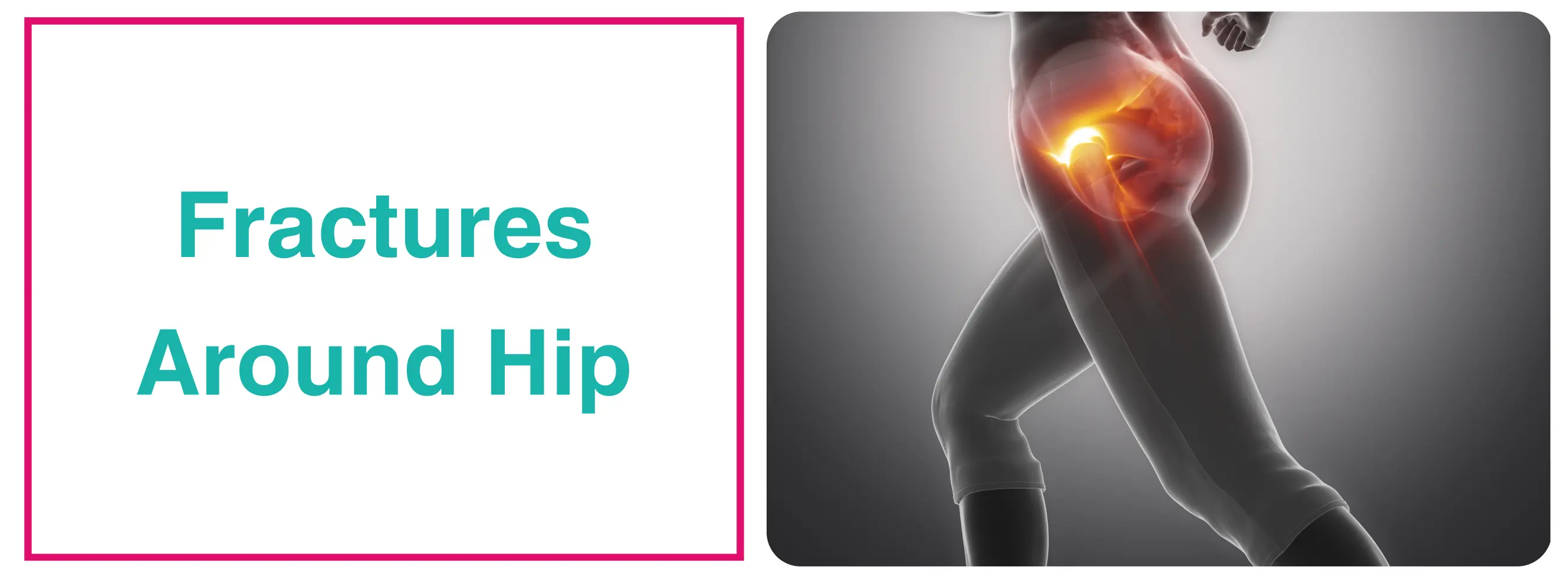 Fractures Around Hip : Diagnosis, Treatment & Cost