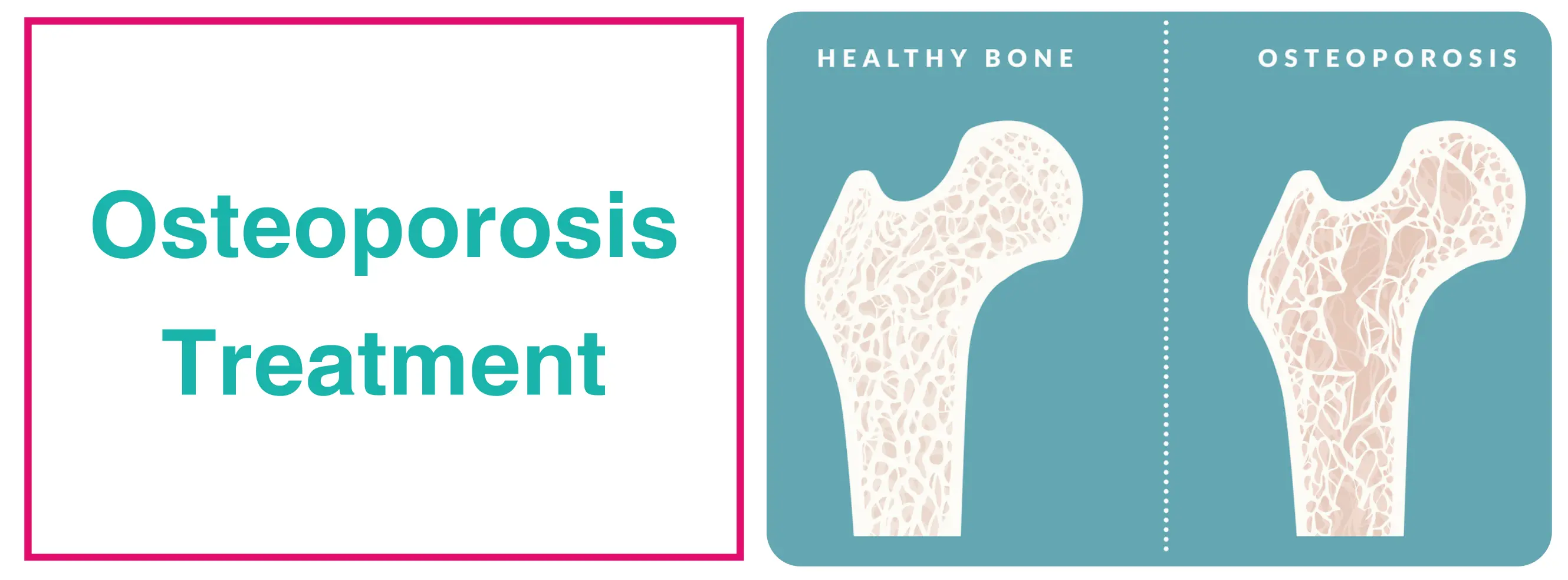 Osteoporosis Treatment In Delhi | Dr. Sankalp Pande