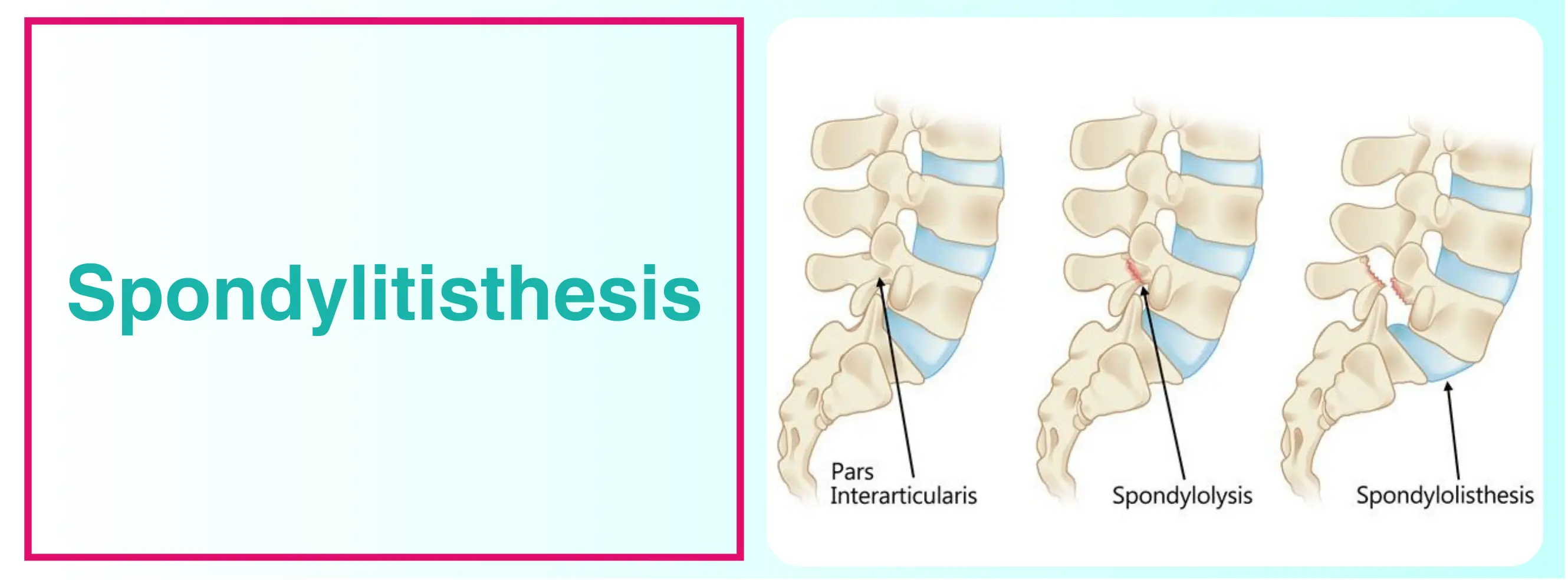 Spondylolisthesis Treatment In Delhi | Dr. Sankalp Pande