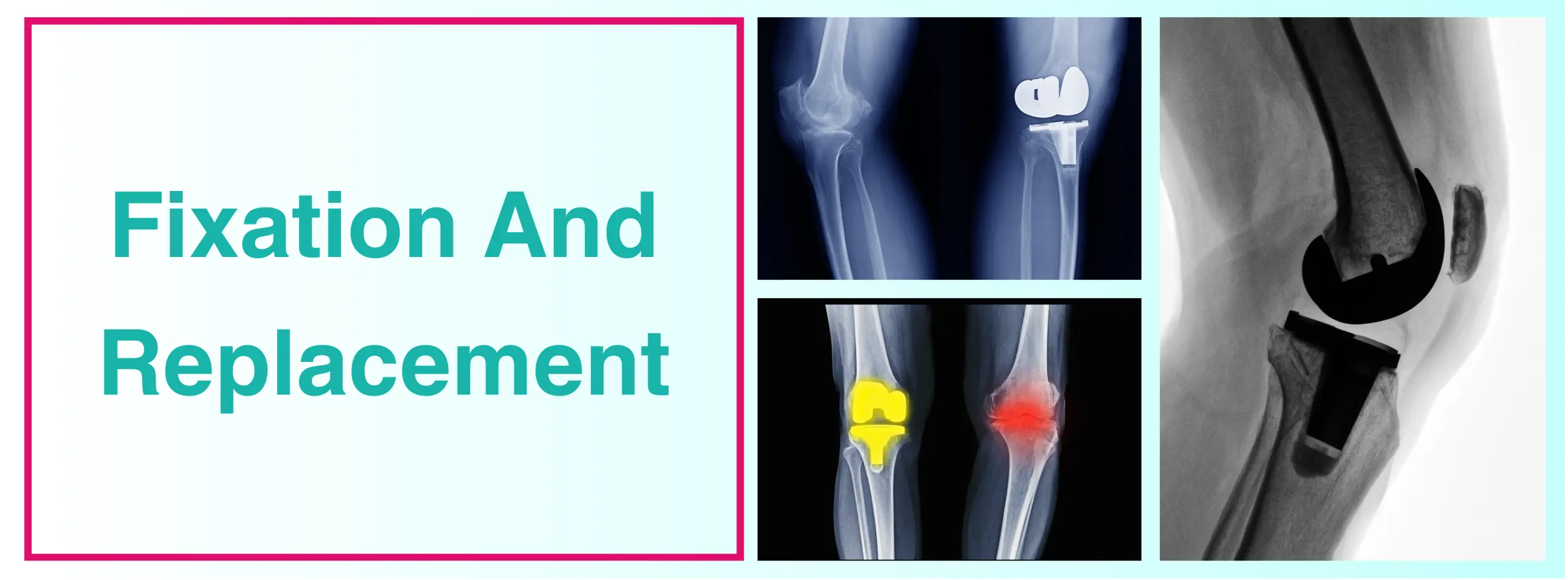 Knee Fixation And Replacement In Delhi| Dr. Sankalp Pande