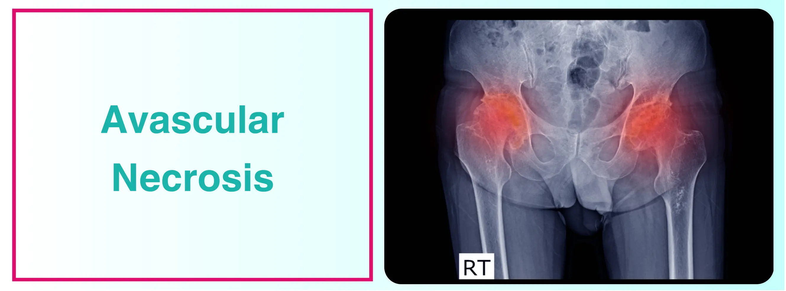 Avascular Necrosis (osteonecrosis) - Diagnosis & Treatment