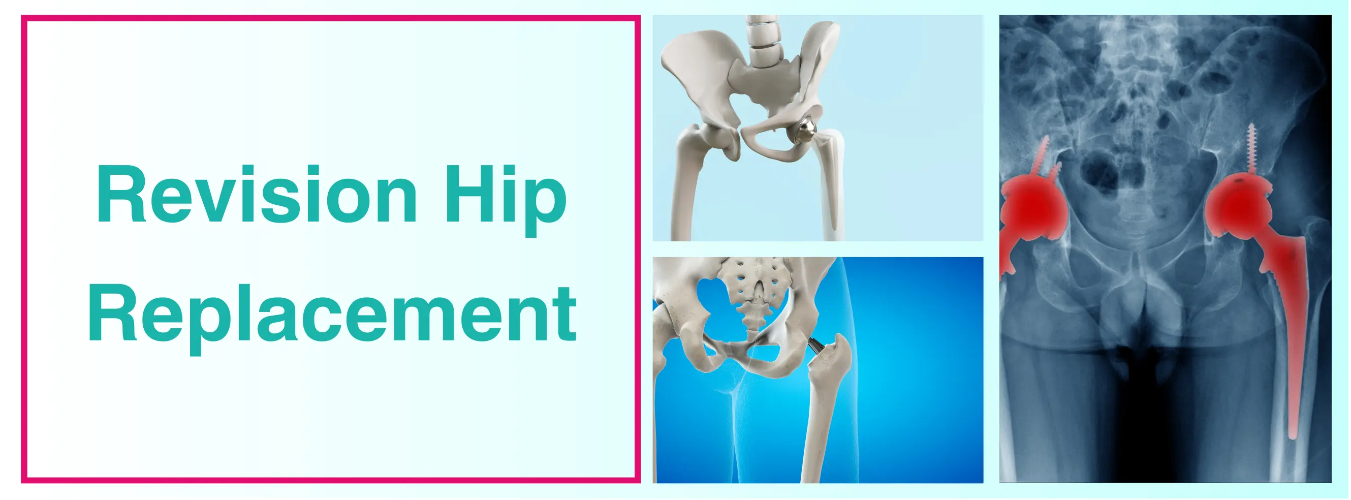 Revision Total Hip Replacement In Delhi | Consult Now With Doctor