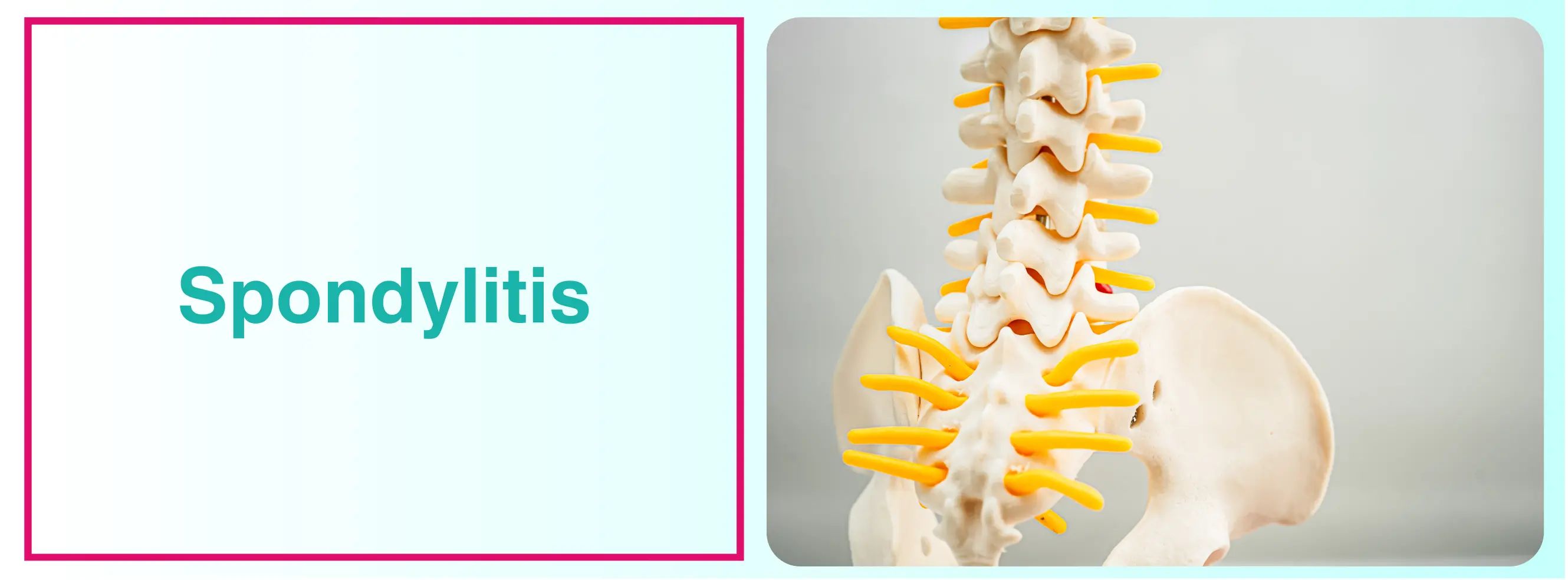 Spondylitis Treatment For Spinal Health: Options And Approaches