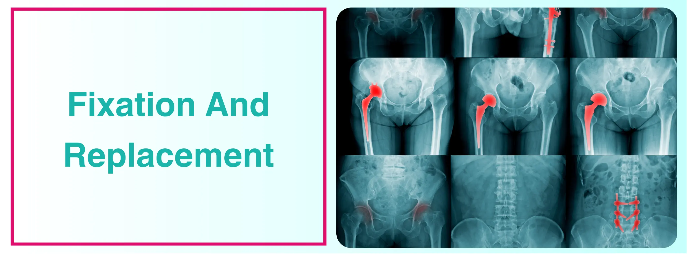 Fixation And Replacement | Fractures Around Hip