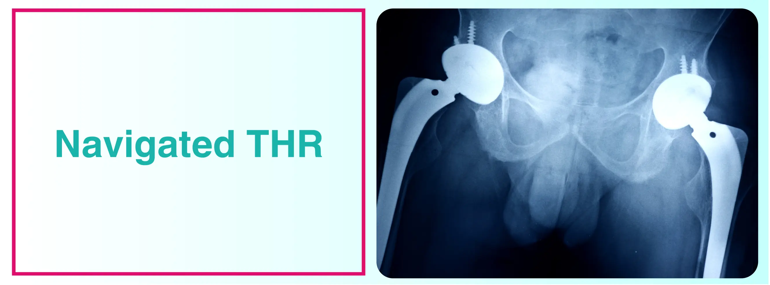 Navigated THR | Total Hip Replacement