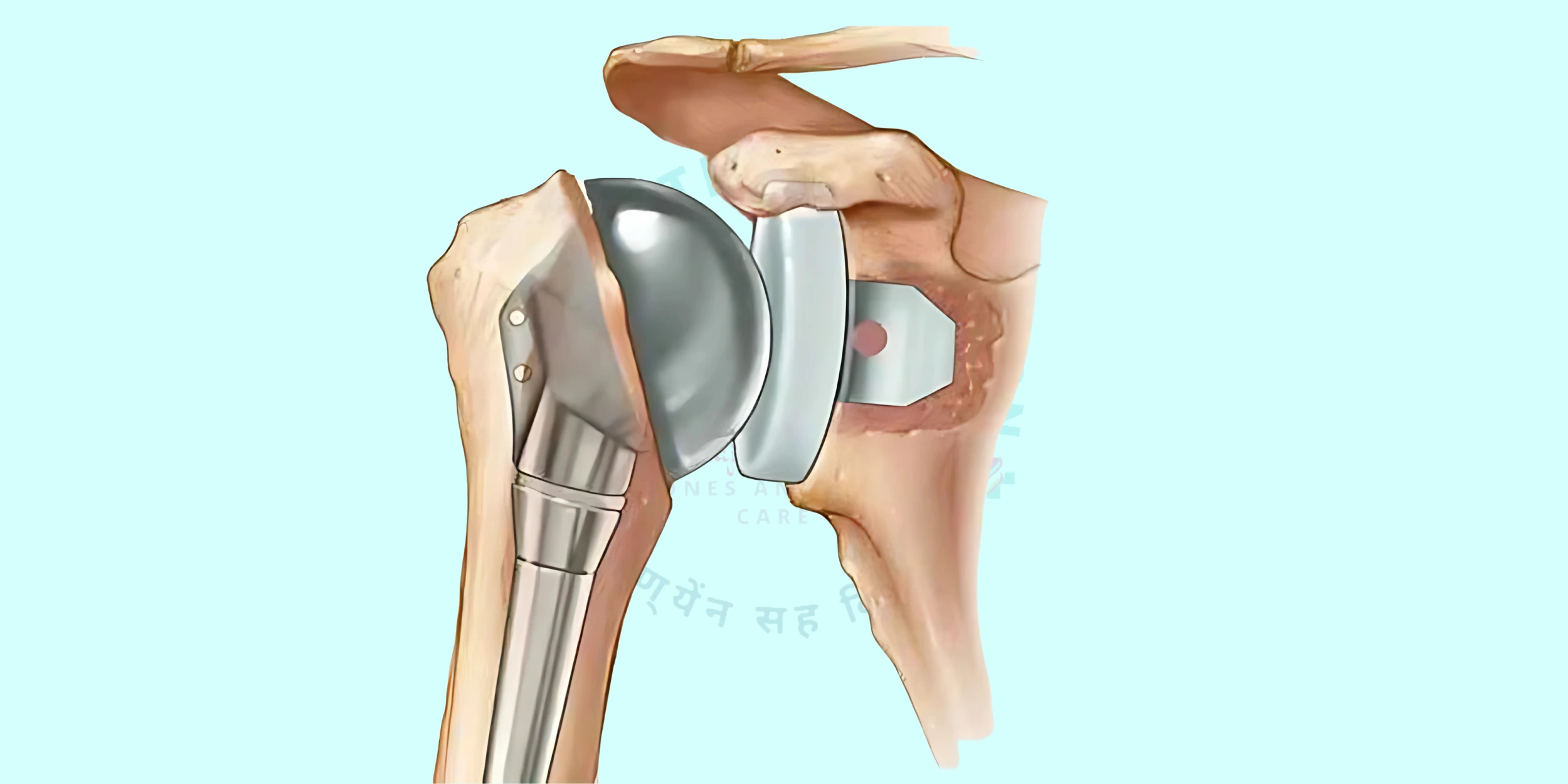 Removal of Damaged Bones