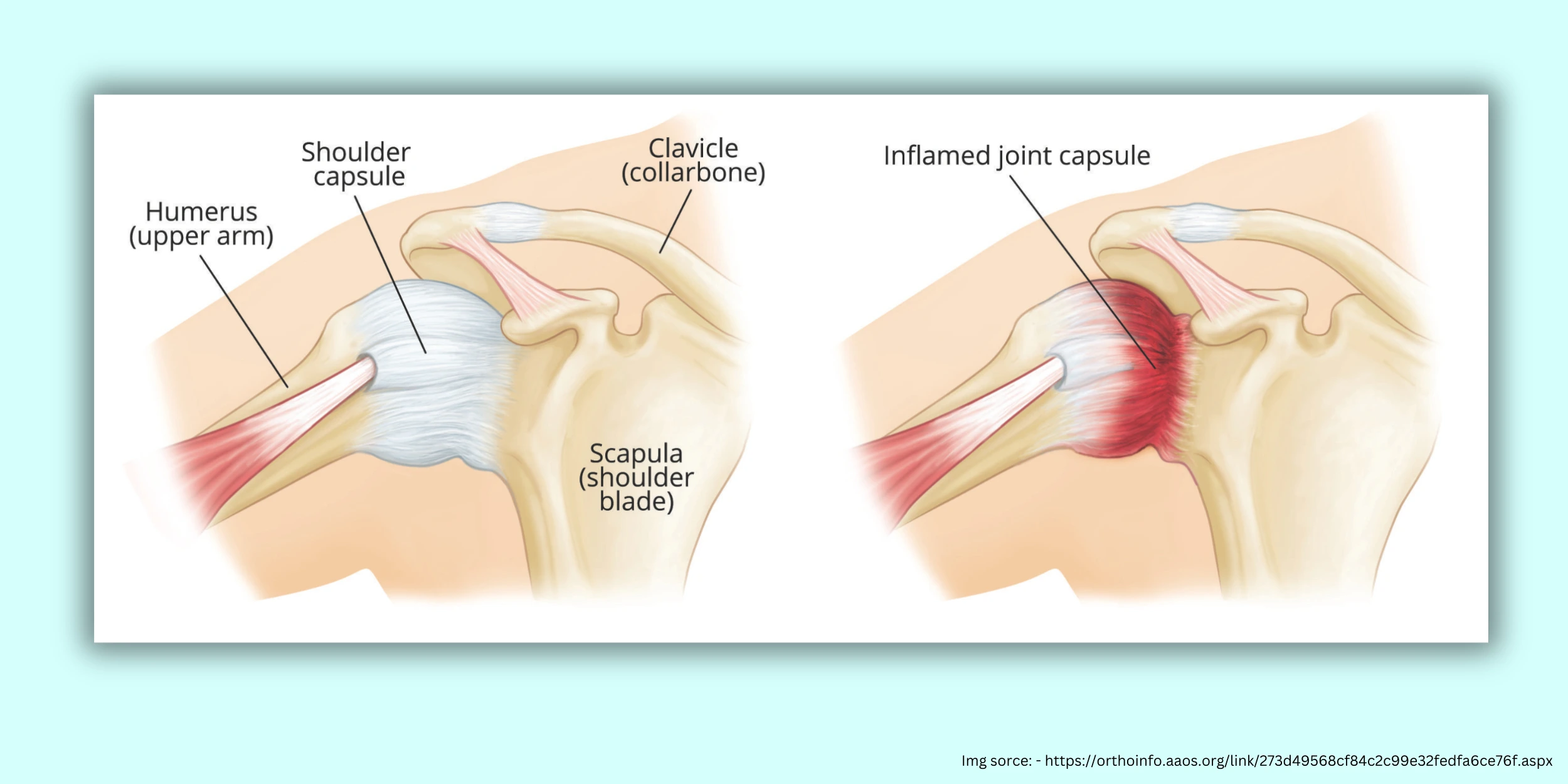 Frozen Shoulder Treatment in Delhi