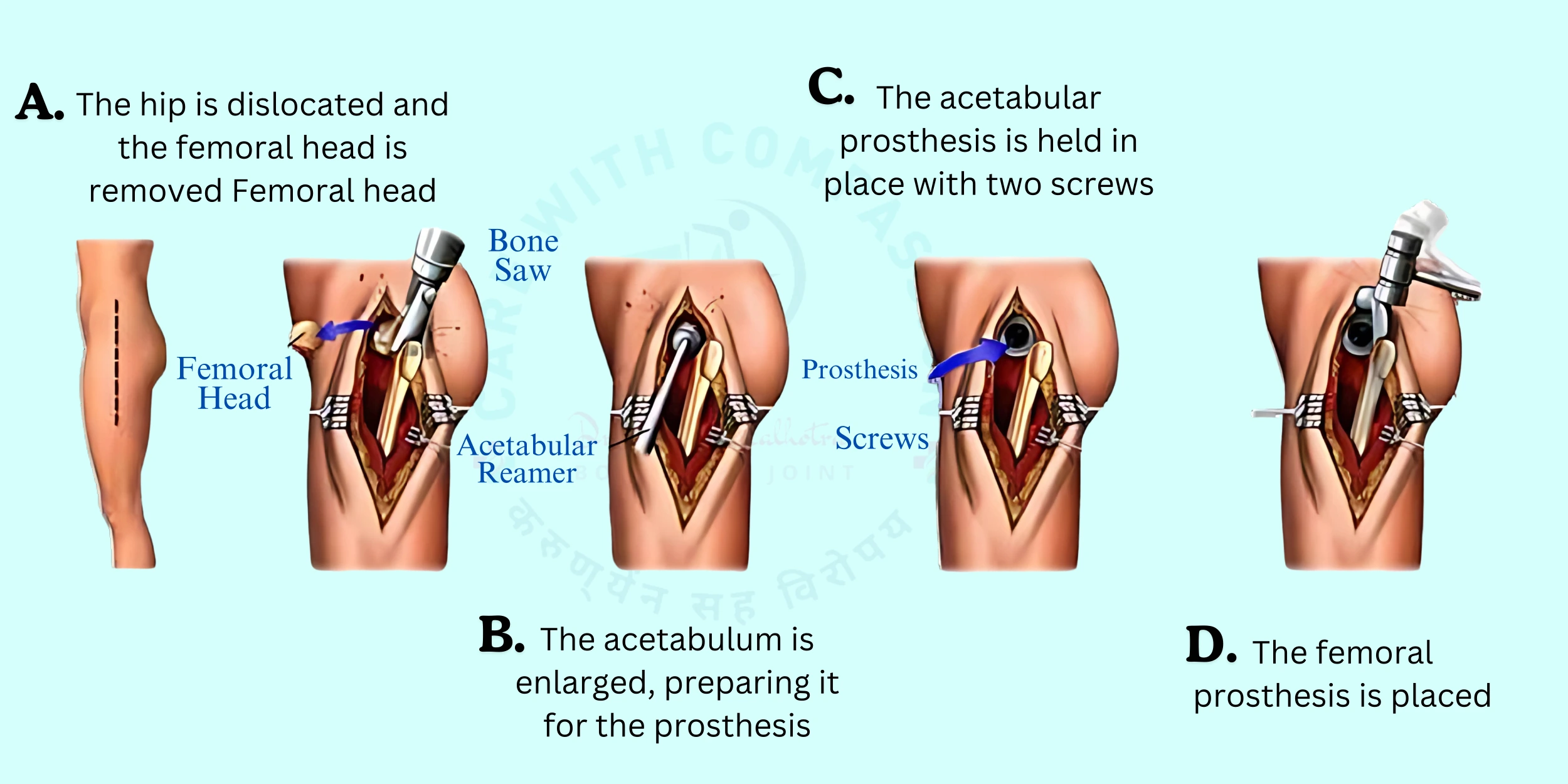 Step-By-Step Process of Hip Replacement Surgery