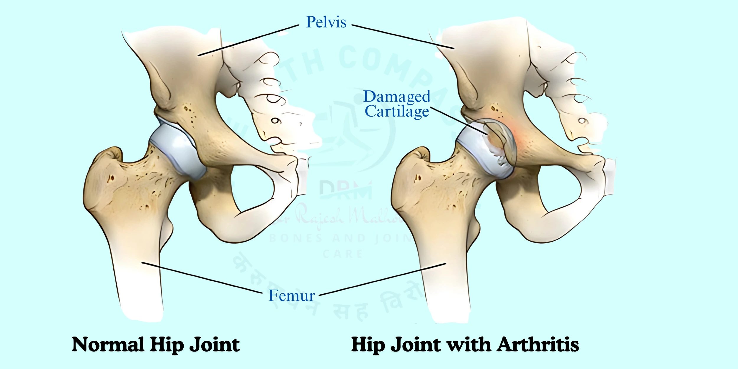 Needs a Hip Replacement