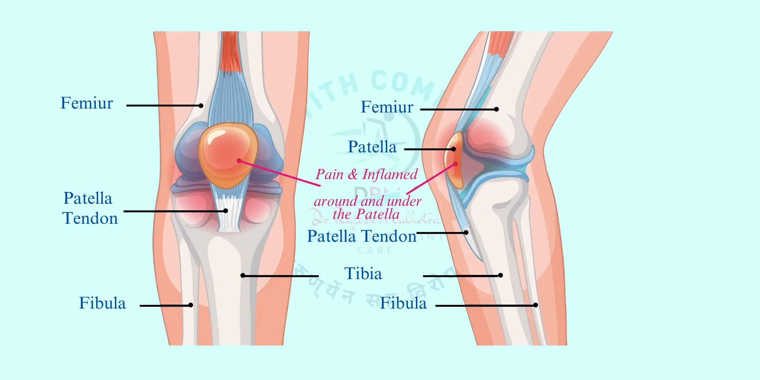 Total Knee Replacement Surgery Process