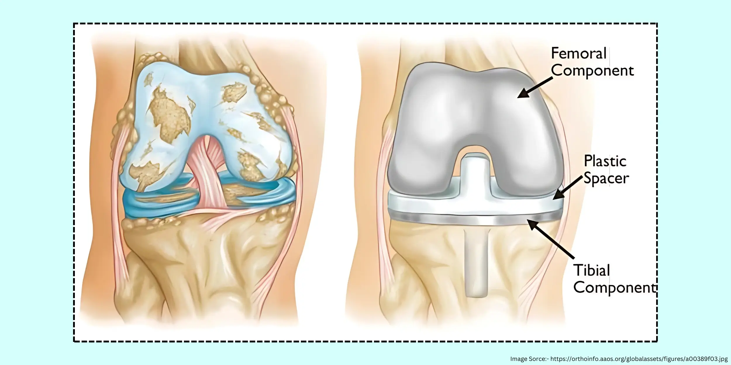 Total Knee Replacement