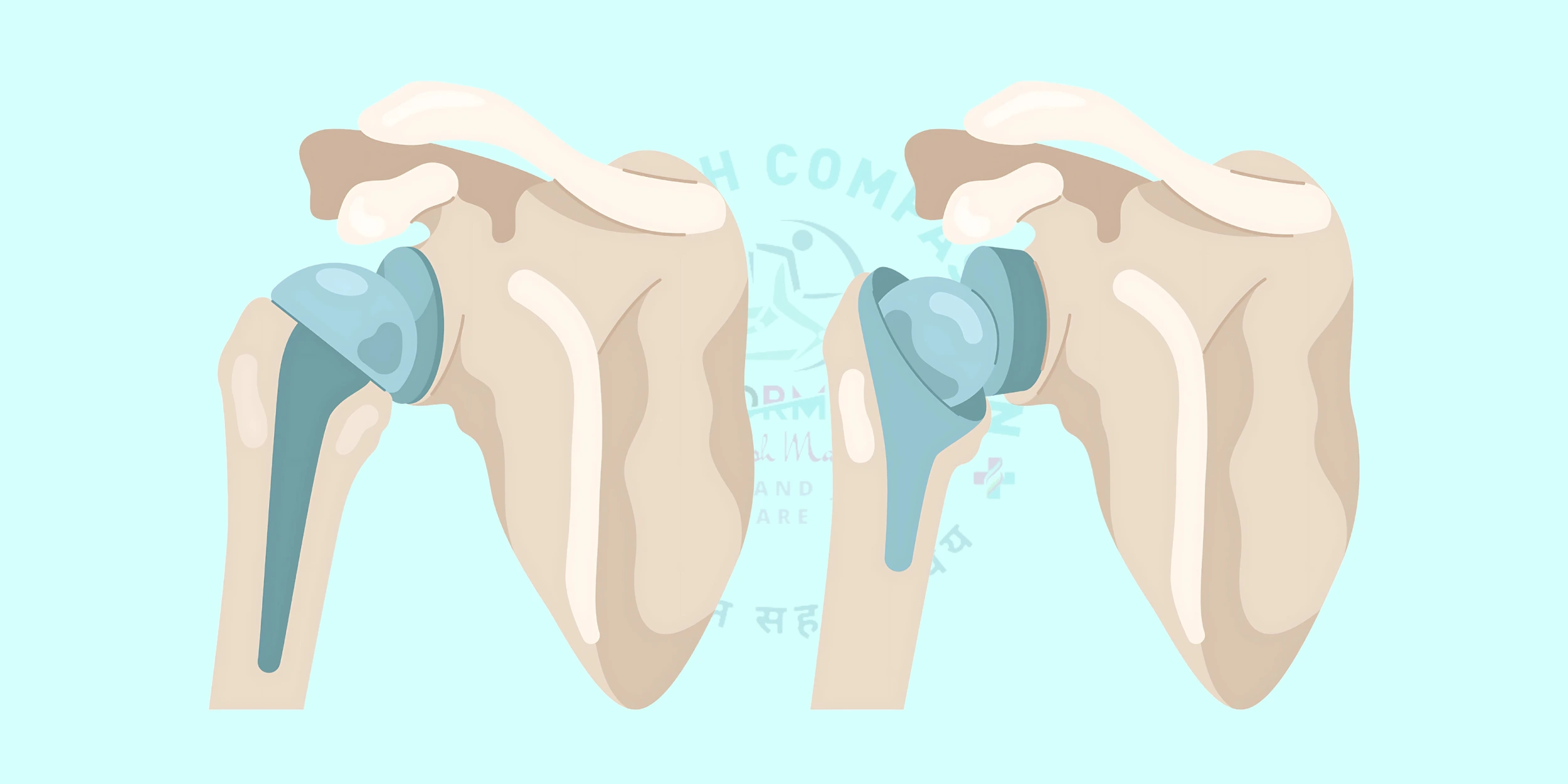 Shoulder Replacement Surgery